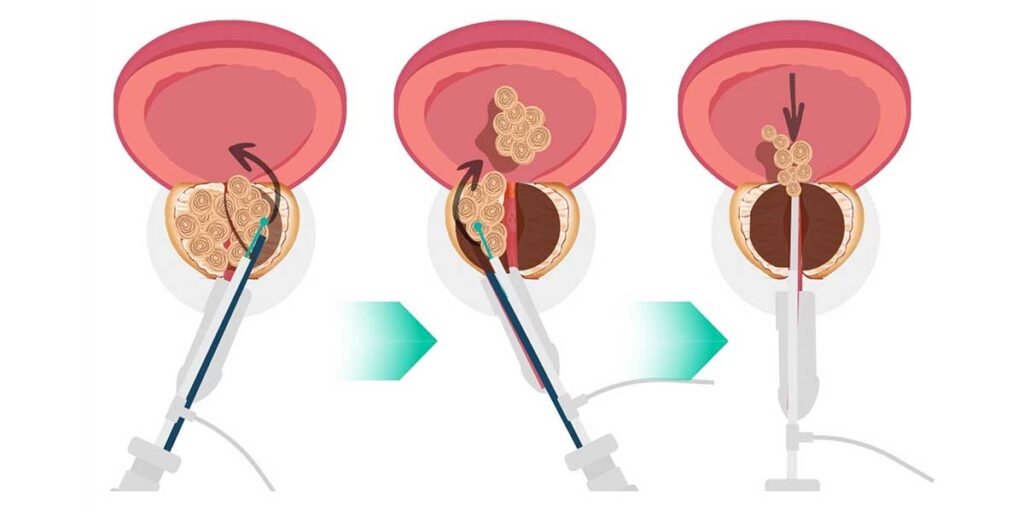 Enucleación Prostática con Láser: La Innovación en el Tratamiento de la Hiperplasia Benigna de Próstata